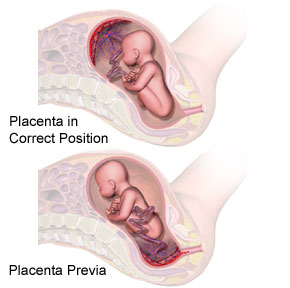 Health Bulletin Co What Every Woman Should Know About Placenta Previa