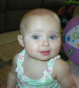 Understanding Vascular Birthmarks On Your Baby